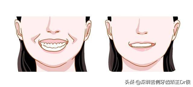露龈笑原因,露龈笑矫正