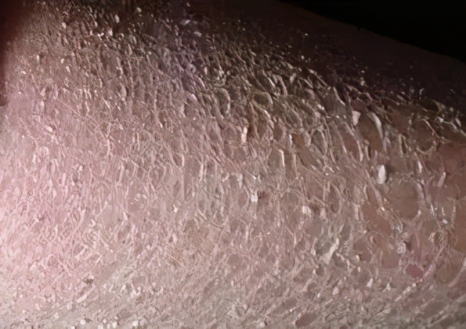 长汗毛导致的鸡皮肤怎么办,女生有鸡皮肤的解决方法