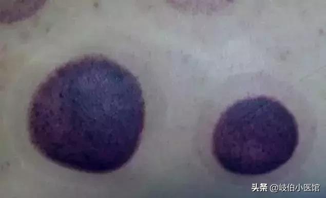 中医火罐疗法有哪些注意事项,中医火罐穴位图