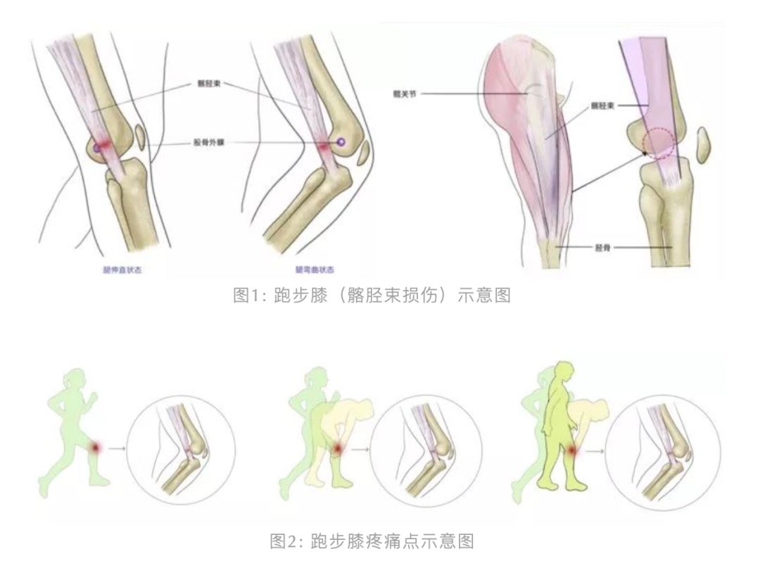 跑步伤膝的预防方法,跑步膝如何纠正