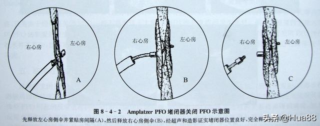早产儿心脏卵圆孔未闭,卵圆孔未闭的原因