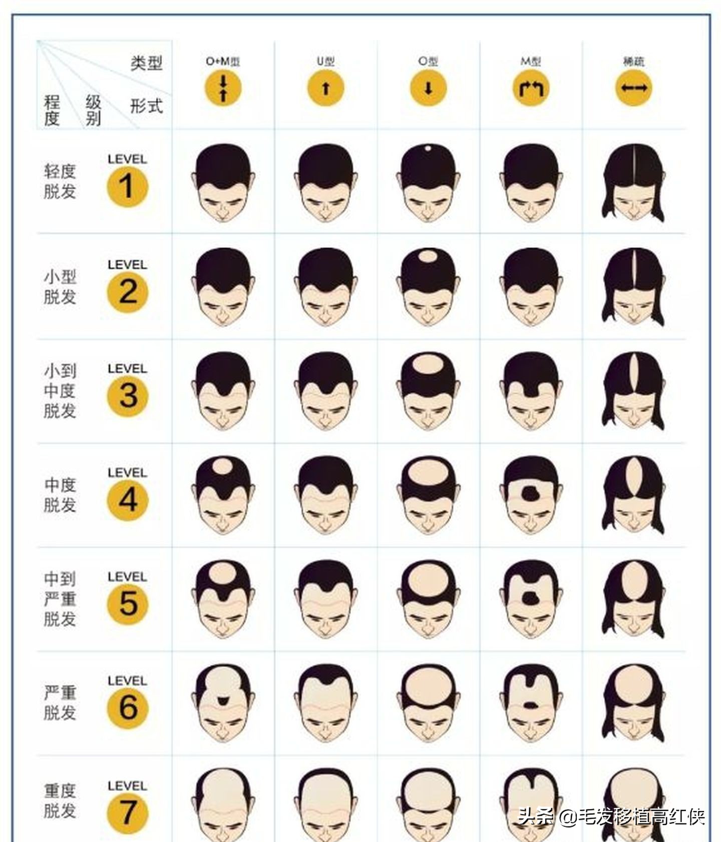 一级到二级脱发严重吗,脱发7级程度