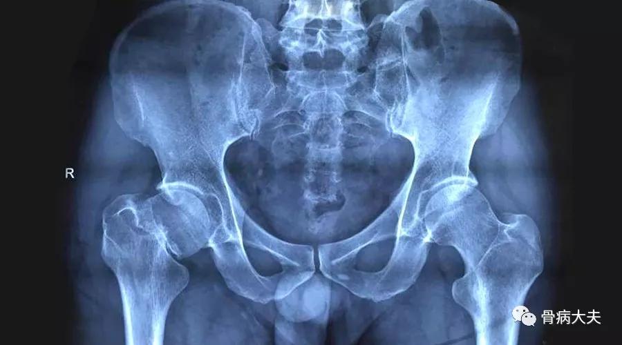 求问中医下肢无力是什么原因,双腿外侧怕冷是股骨头坏死吗