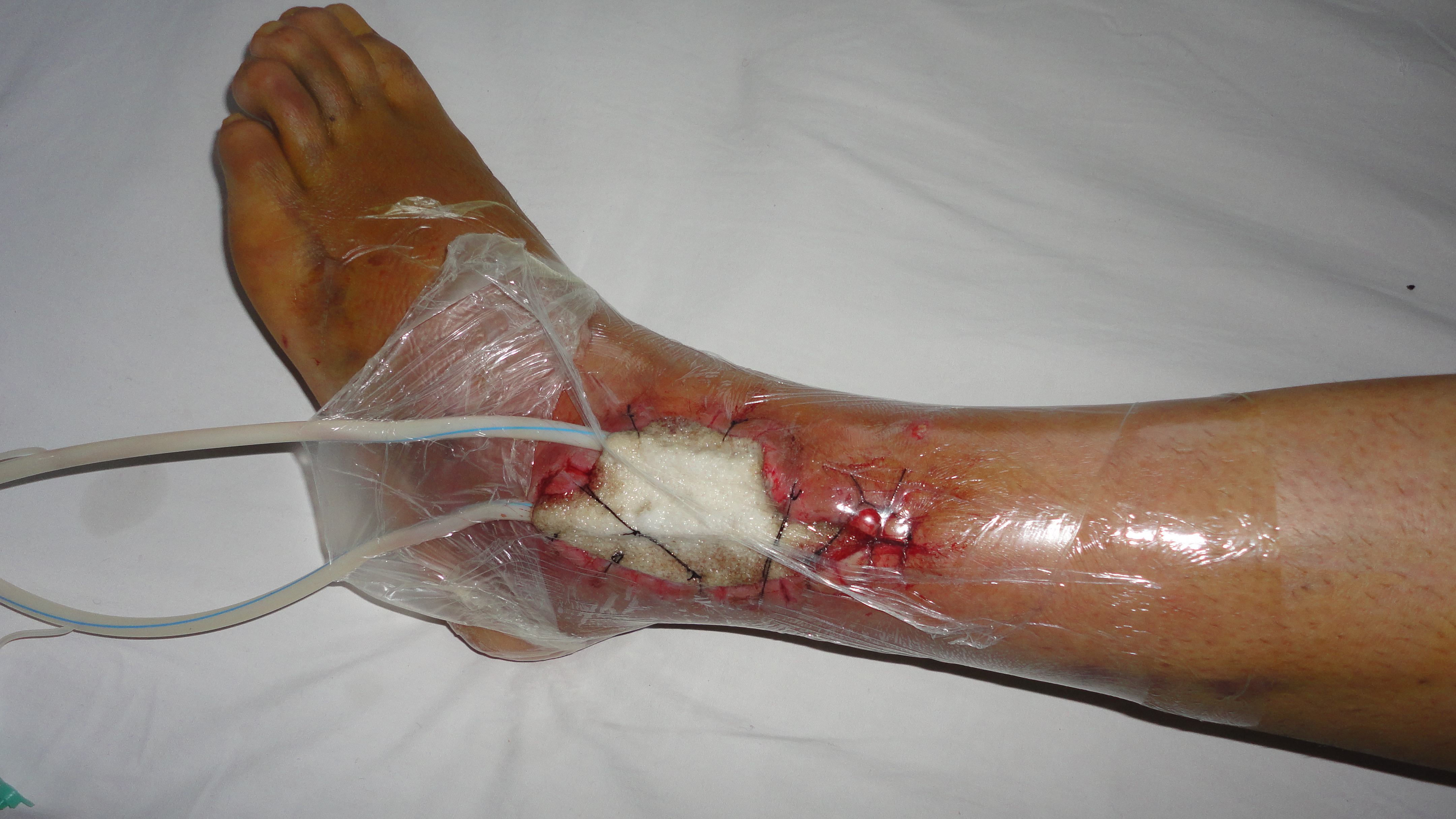 手术后麻药导致头痛多久才能痊愈,感染后一直头痛怎么办