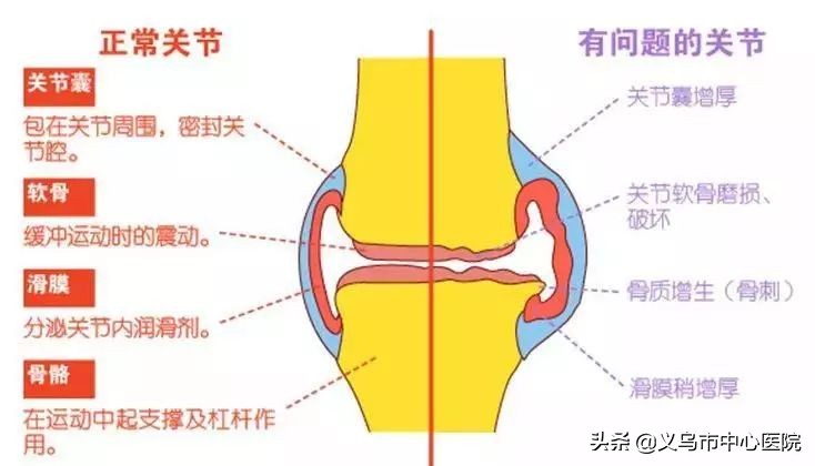 骨关节病变的克星,骨关节炎克星
