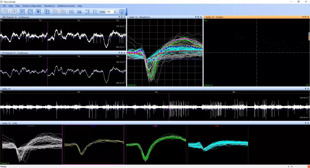 晶体植入手术的分享,可调微丝阵列电极
