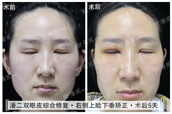 双眼皮术后恢复不一致正常吗,双眼皮术后看着不对称