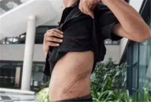 当年卖肾买苹果手机的高中生,得到147万赔偿之后,如今过得怎样