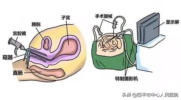 宫腔镜腹腔镜手术一起做多少钱,宫腔镜和腹腔镜手术各需多少钱