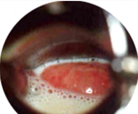 黄色豆腐渣分泌物外阴瘙痒,黄色分泌物伴有内阴瘙痒用什么药