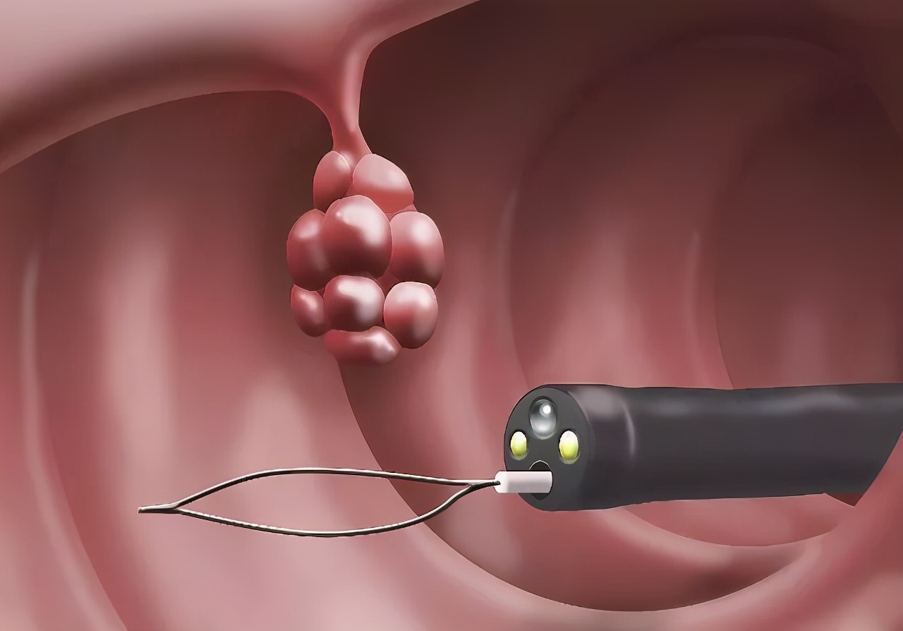 肠镜检查预防什么病,哪些肠镜结果需重视