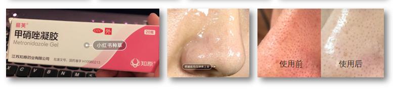 去黑头的药膏国货之光,国货祛黑头药膏排行榜