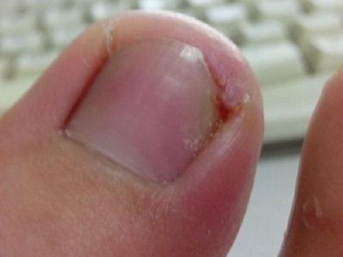 甲沟炎去修脚店要留指甲吗,脚指甲有甲沟炎怎么处理