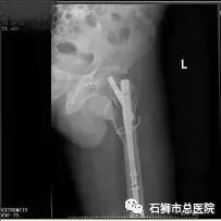 石狮市骨科医院,石狮市总医院骨科多少钱