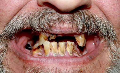 为什么吸毒的人掉牙齿,吸毒的人为什么会烂牙齿