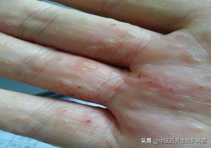 汗疱疹反复发作,怎么办?医生教你几招,帮你舒舒服服过夏天