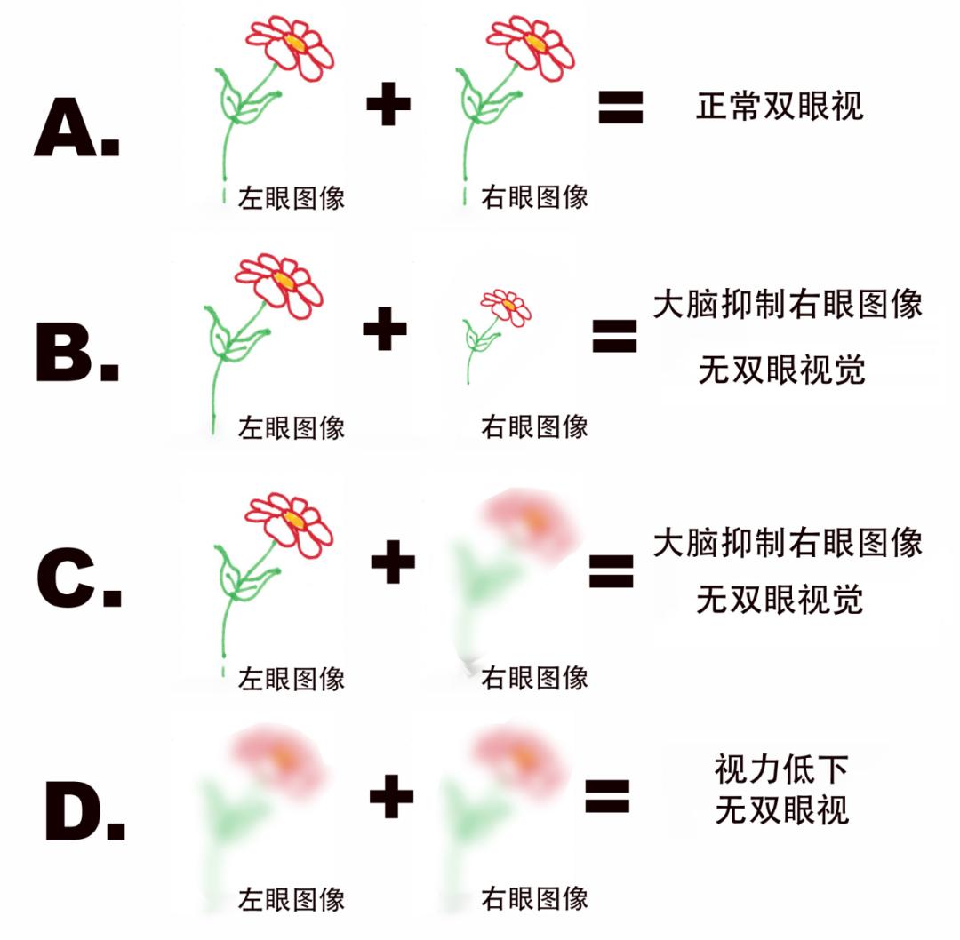 双眼弱视矫正后度数一样怎么训练,科飞视觉对弱视训练有用吗