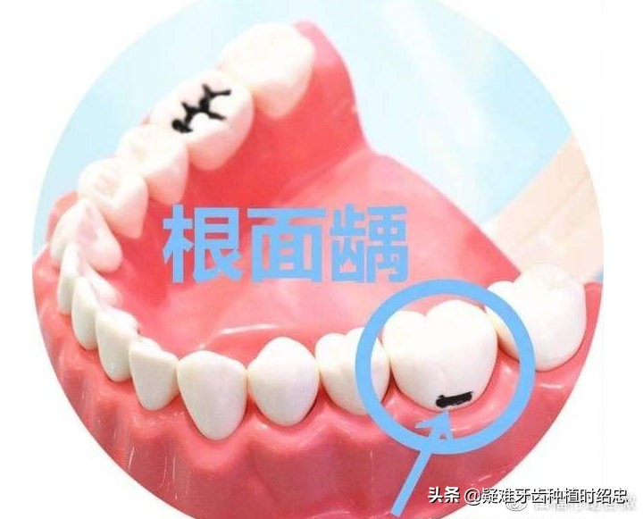 牙为啥会从里面开始烂,牙齿从牙根开始坏怎么回事