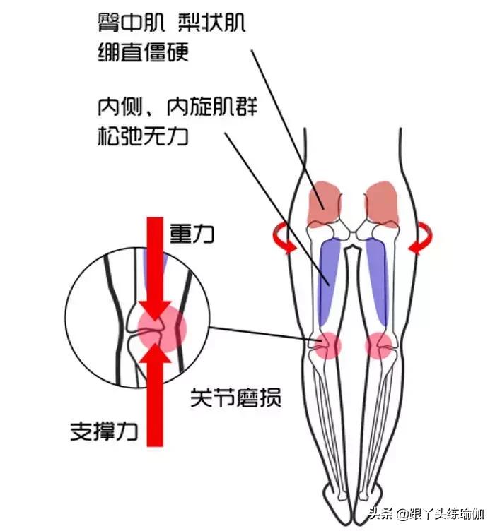 o型腿不好看怎么矫正,既能改善o型腿又能瘦腿的方法