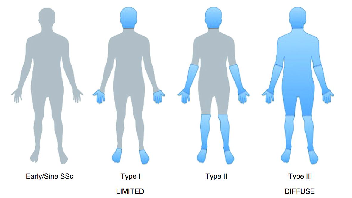 多发性硬化症和系统性硬皮病,系统性硬皮病有什么症状