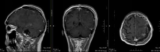 七十岁老人头长肿瘤怎么治,86岁脑袋长了鸡蛋大的肿瘤