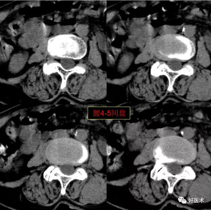 腰部ct需要注意事项,做腰部ct需要注意的事项