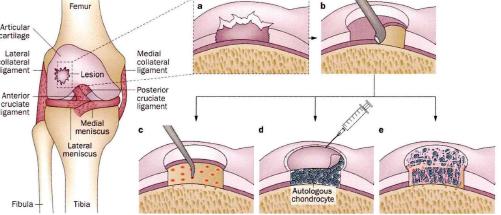 关节软骨损伤为什么难以治疗?听听医生怎么说