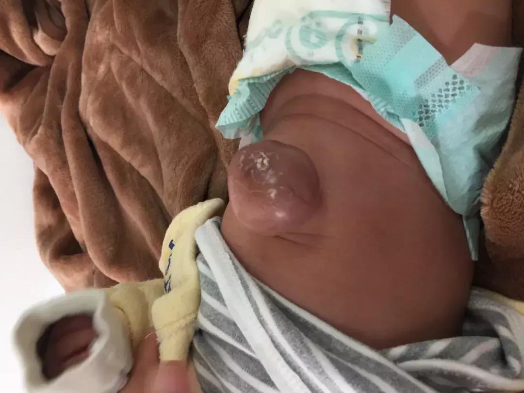 宝宝得脐疝一般多久能好,成人脐疝4-5公分用做手术吗