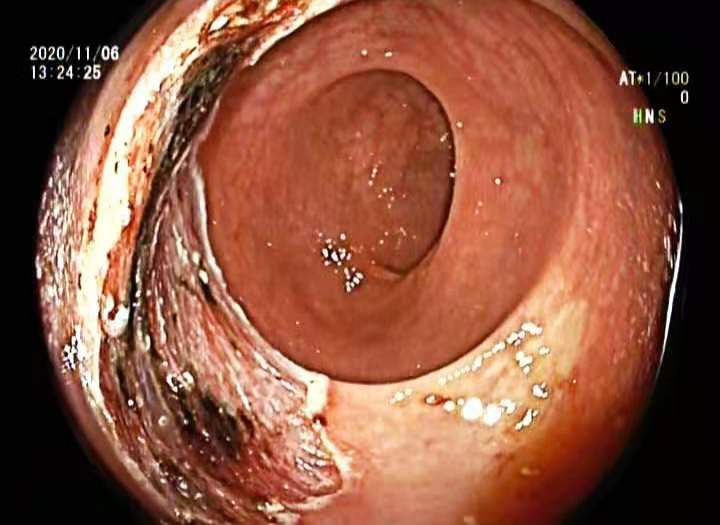 大同守佳消化病医院消化内科，行内镜黏膜下剥离术，成功切除4厘米早期直肠癌