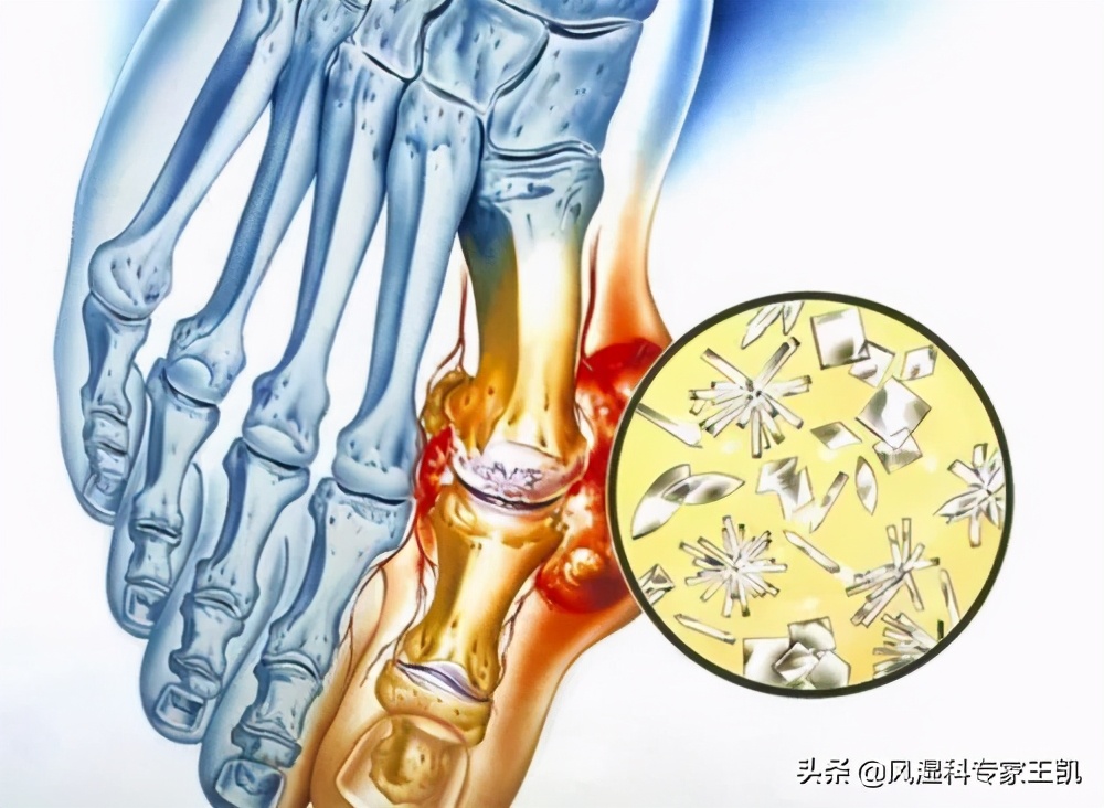 类风湿关节炎的先兆,类风湿关节炎能治愈吗
