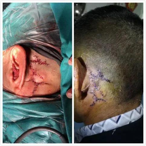 中耳炎里面长了个瘤子,中耳炎长瘤子