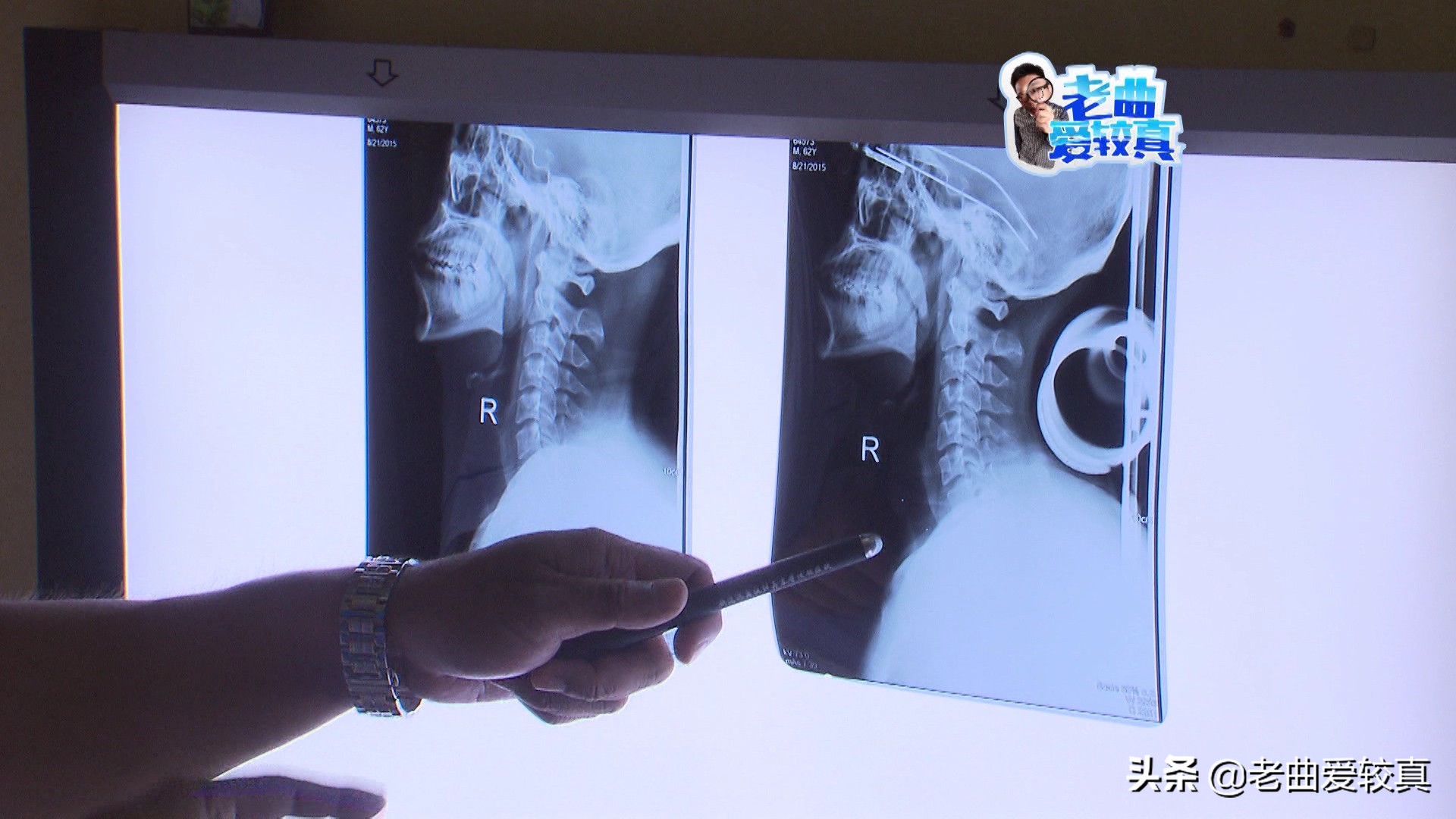 枕瓶子真的能治好颈椎病吗,酒瓶子当枕头可以治疗颈椎病吗