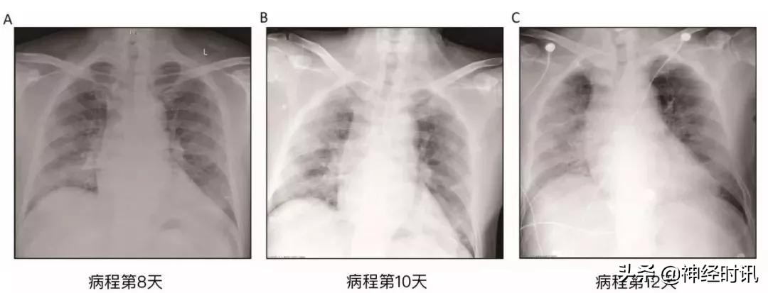 全球新冠肺炎确诊病例统计报告,全世界首例新冠肺炎确诊
