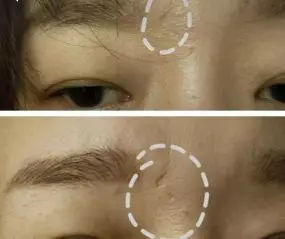 怎么填补脸上的痘坑,痘印痘坑修复激光手术