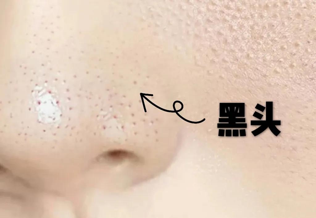 一招教你轻松去黑头,黑头去除小妙招明星