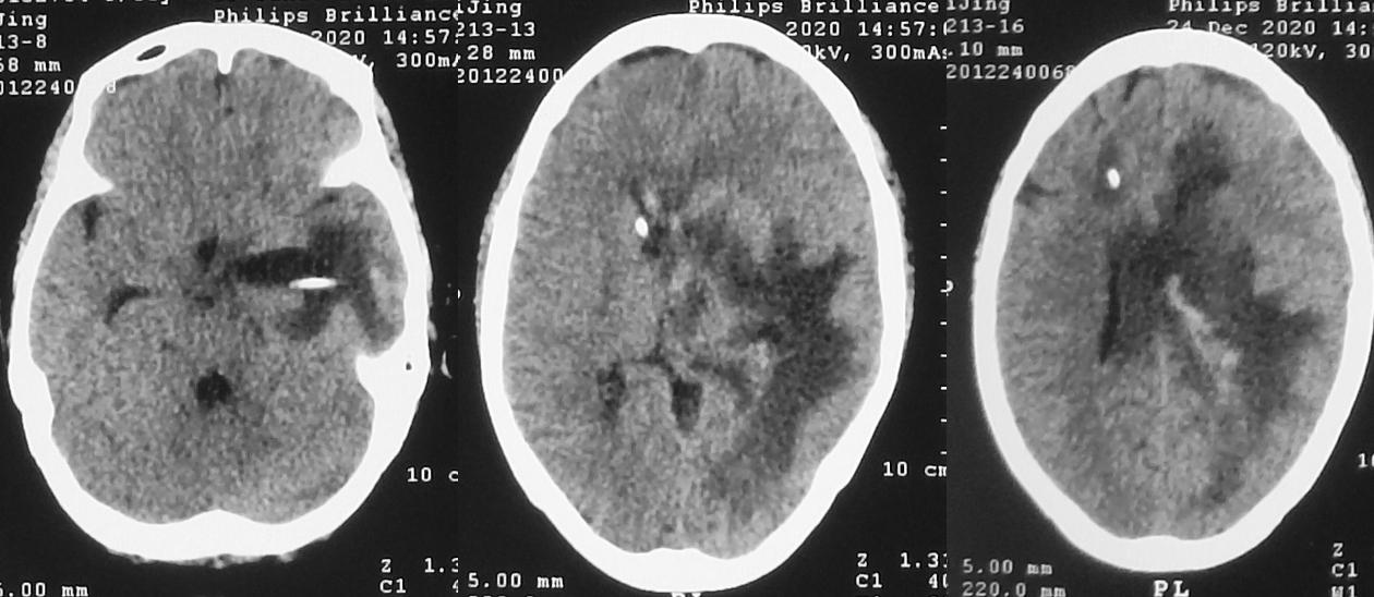 脑脓肿合并脑膜炎需要手术吗,脑脓肿进入左侧脑室严重吗