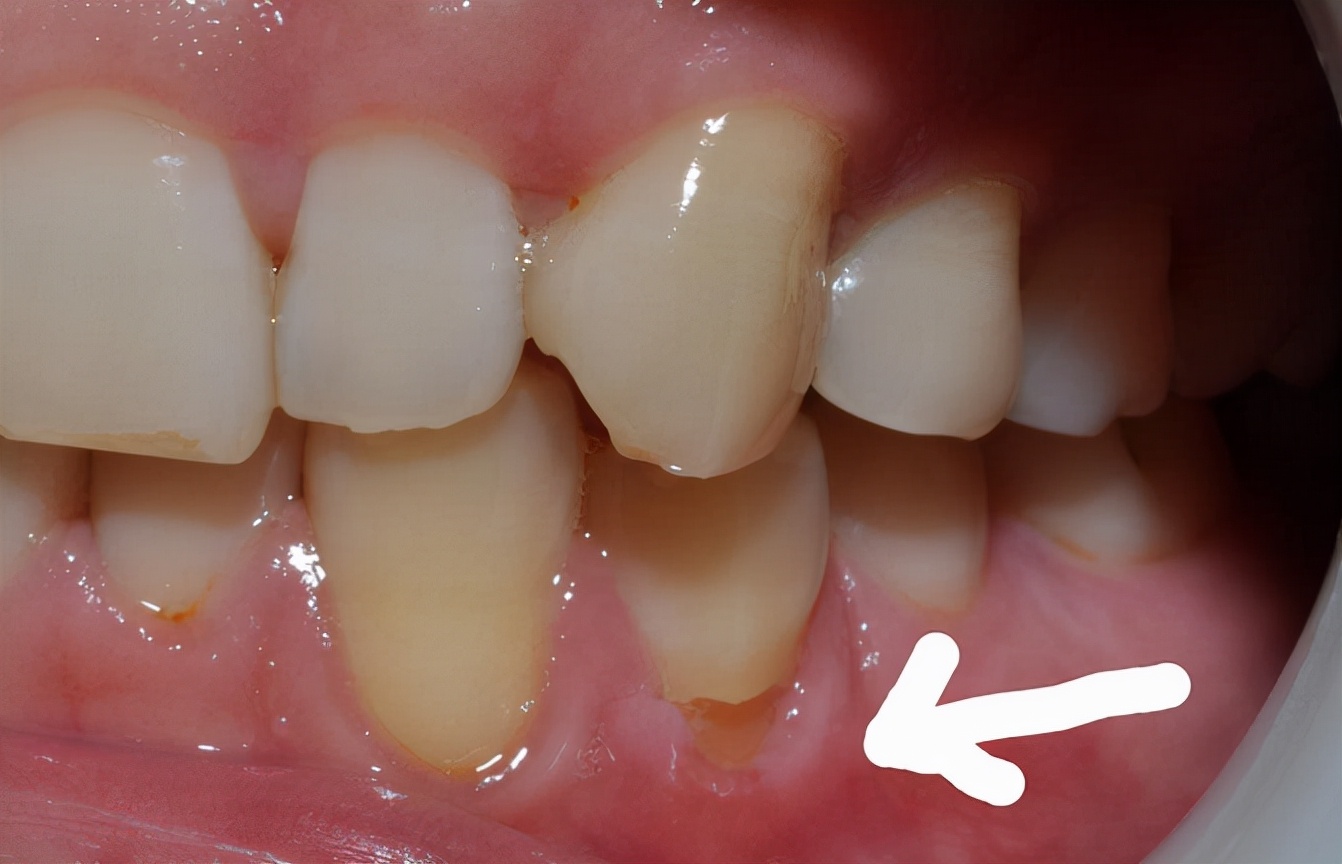 牙齿酸软中医最快解决办法,牙齿酸软怎么治最好的办法