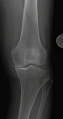 膝关节阶梯治疗ppt,膝关节骨性关节炎阶梯化治疗