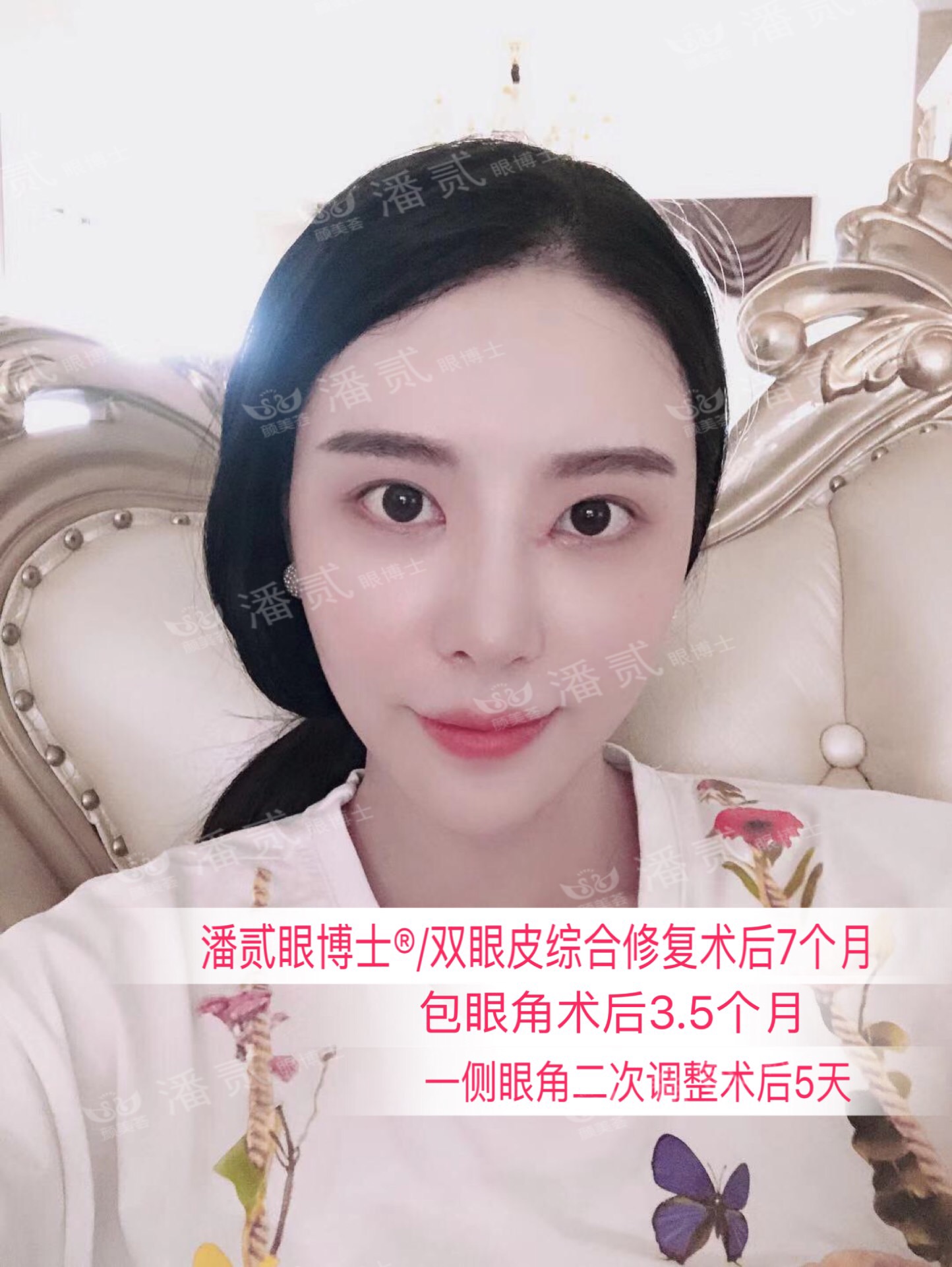 开内眼角会留疤的照片,开内眼角的疤痕变白色了怎么办