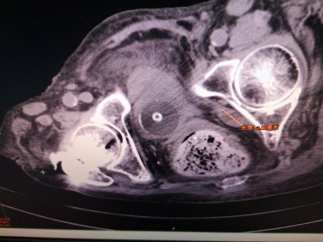肝硬化腹水中药治好病例,肝硬化腹水中医辨证论治