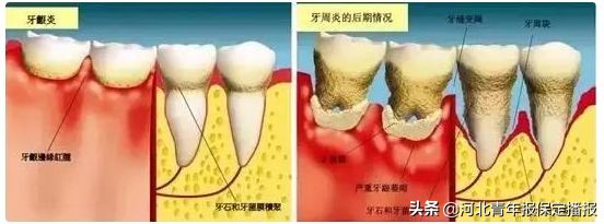 广大口腔公益种牙补贴,领取口腔优惠