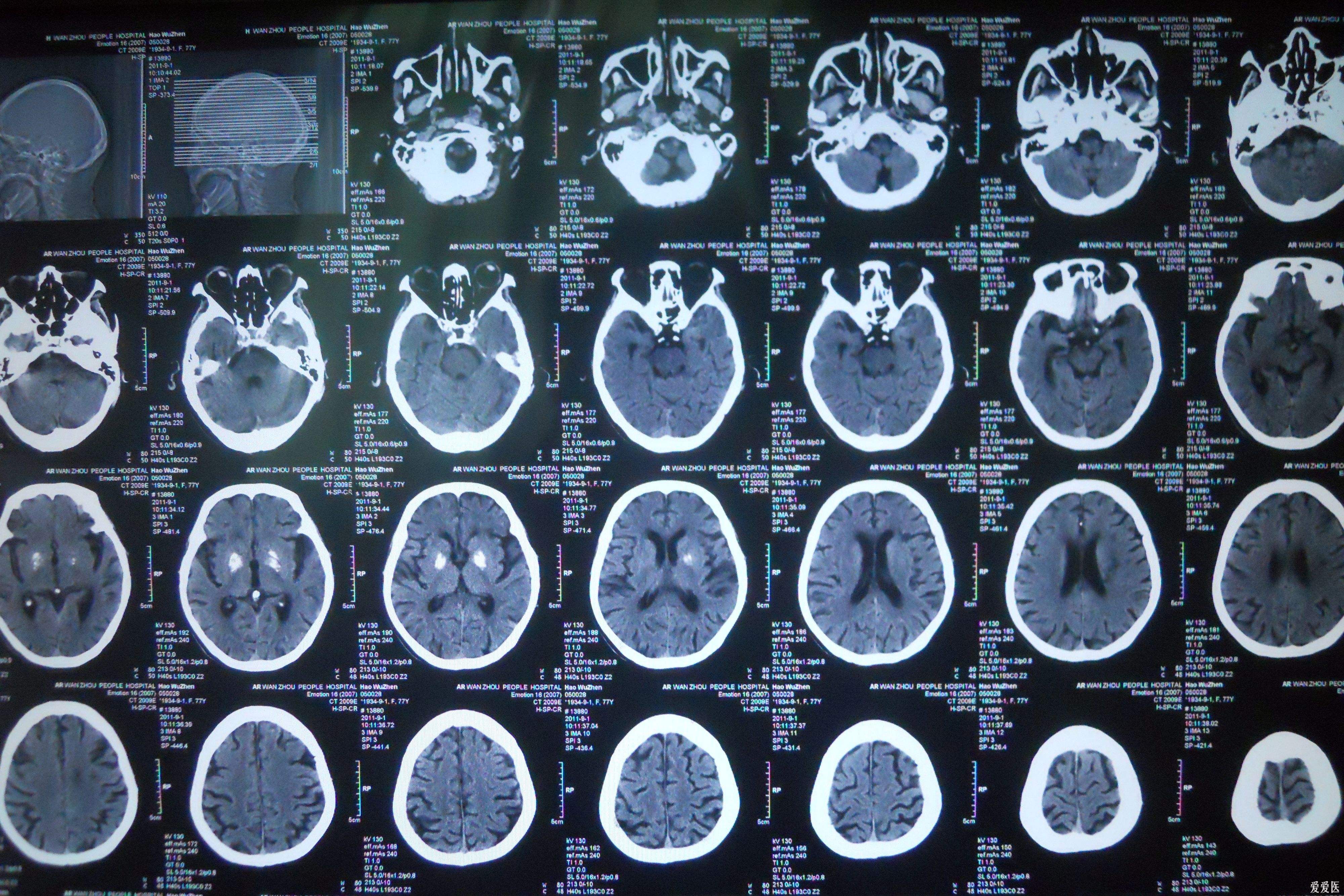 ctmr比较,ct和mri图片对比
