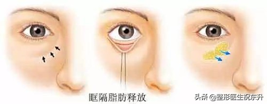 做眼袋去掉脂肪眼袋更松弛了,做眼袋眶隔释放怎么还有泪沟