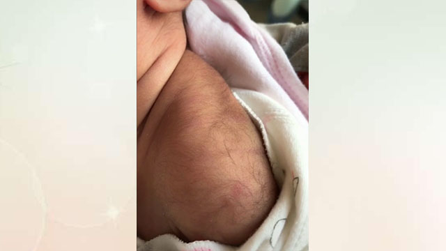 刚出生的婴儿背上长毛怎么回事,新生儿后背有黑色长毛