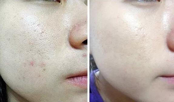 黑头闭口连根拔起,黑头粉刺连根拔起留坑