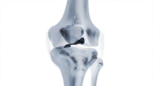 走走路膝盖就软一下怎么回事,走路时一条腿软摔倒怎么回事