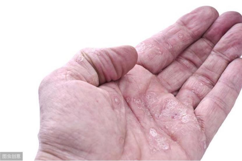 银屑病一直不好怎么办,银屑病总是消不下去