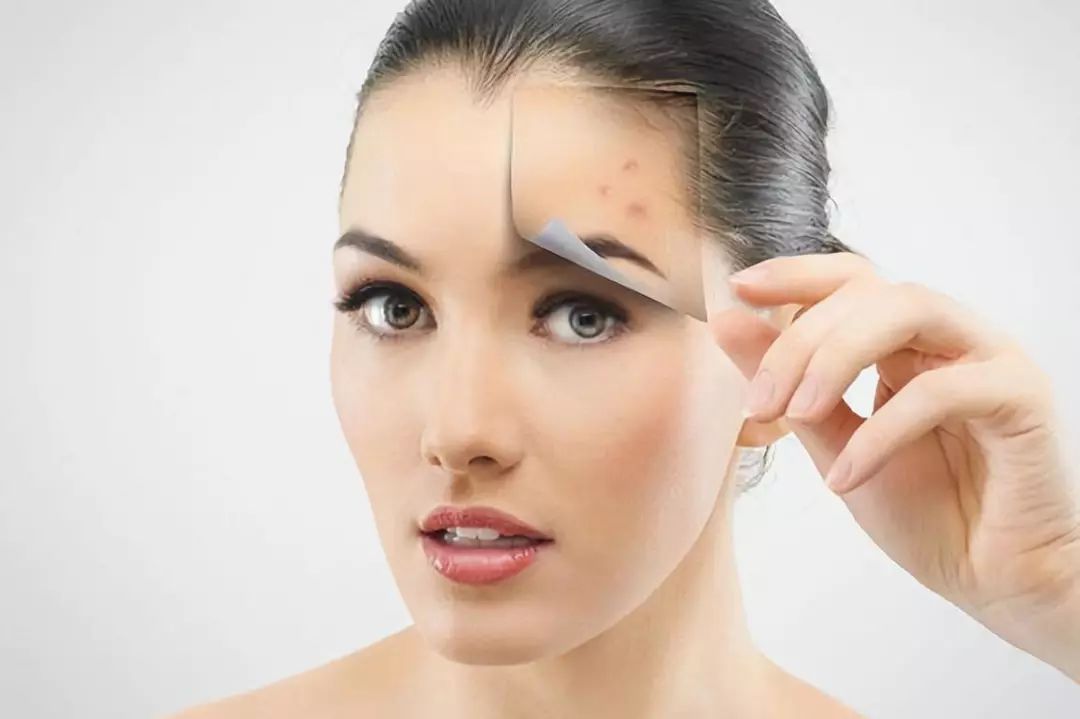 脸上有闭口怎么办？这4种护肤方法，帮你解决难题