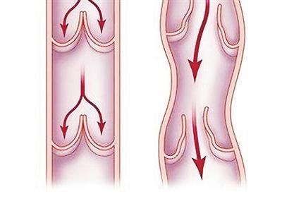 小孩腿静脉曲张,孩子腿上有静脉曲张
