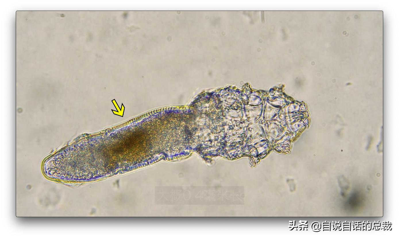 毛囊异型,毛囊里的异形物